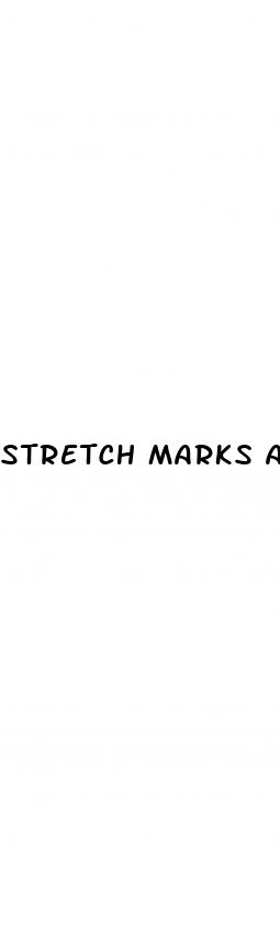 stretch marks after weight loss
