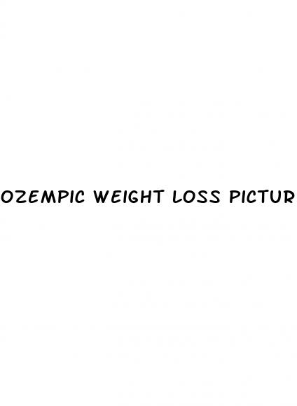 ozempic weight loss pictures