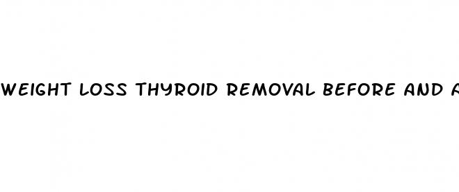 weight loss thyroid removal before and after