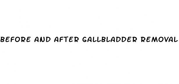 before and after gallbladder removal weight loss