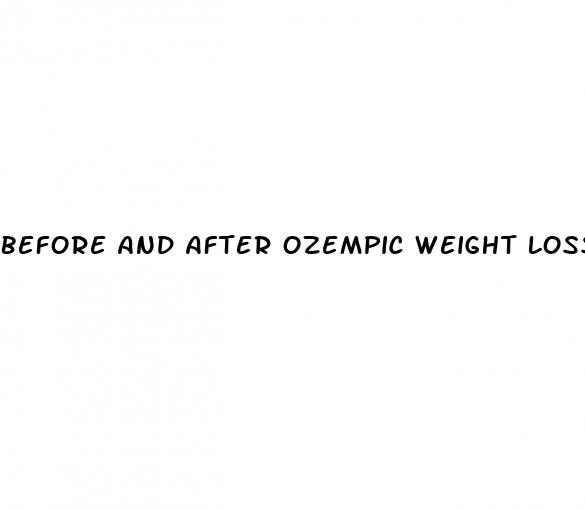 before and after ozempic weight loss