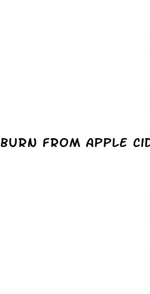 burn from apple cider vinegar