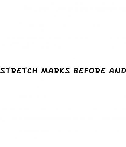 stretch marks before and after weight loss