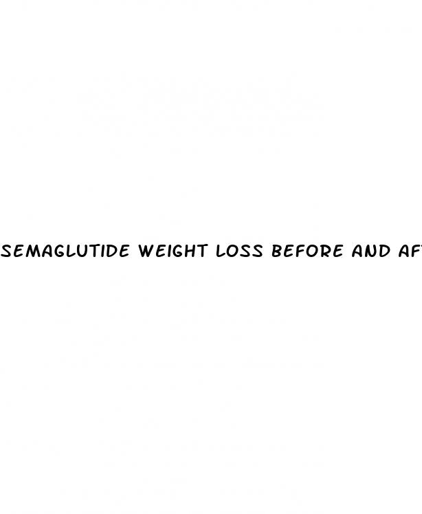 semaglutide weight loss before and after pictures