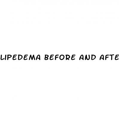 lipedema before and after weight loss