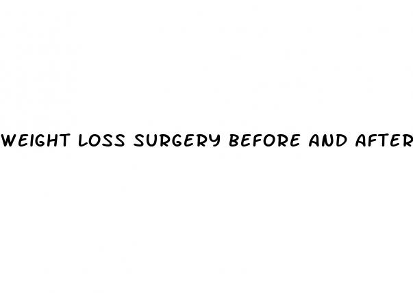 Weight Loss Surgery Before And After