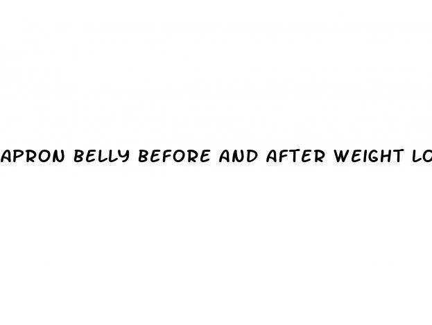 apron belly before and after weight loss