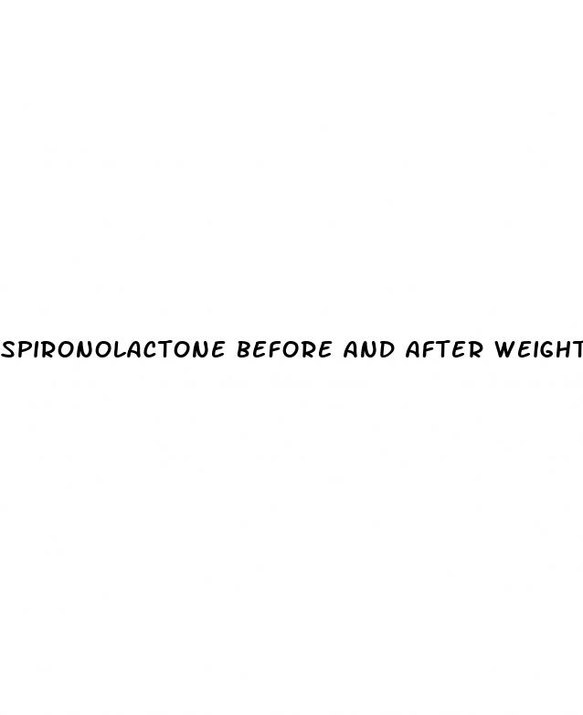 spironolactone before and after weight loss